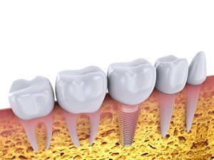 9 Things You Should Know About Dental Implants dentist Beaudesert