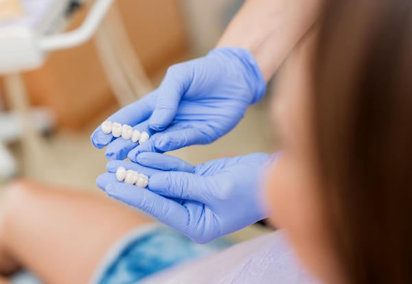 Dental Veneers – How Long Can They Last?