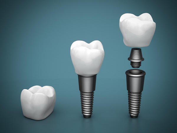 Dental Implants in Beaudesert: Should You Shop Around?