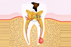 The Ultimate Guide to Root Canal In Arana Hills